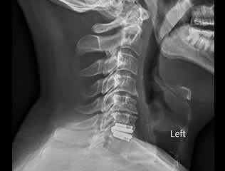 Total Cervical Disc Replacement