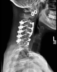 Posterior Cervical Fusion - Neck Pain Explained